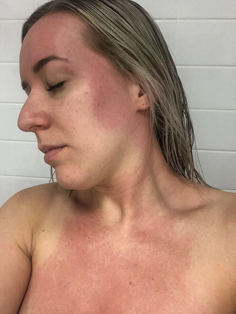 Rash on boobs after breast augmentation. Should I be concerned? (Photo)